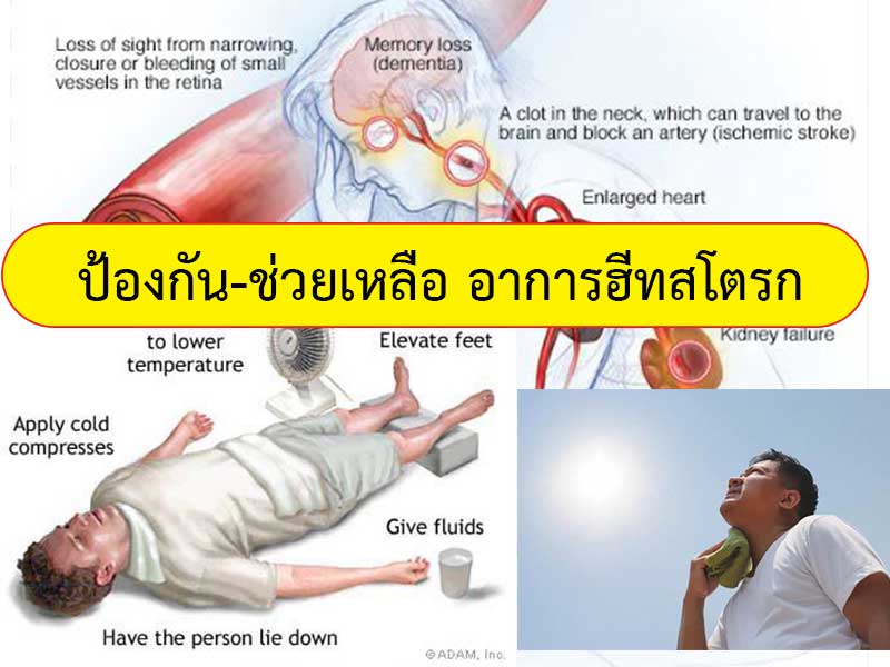 อาการและการป้องกัน โรคฮีทสโตรก (Heat Stroke) หรือโรคลมแดด | ภัยร้ายฤดูกาลนี้